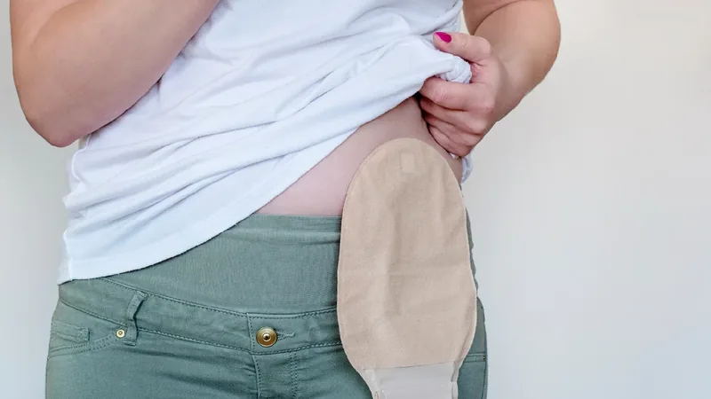 ¿Qué es una ostomía? Tipos, cuidados y calidad de vida